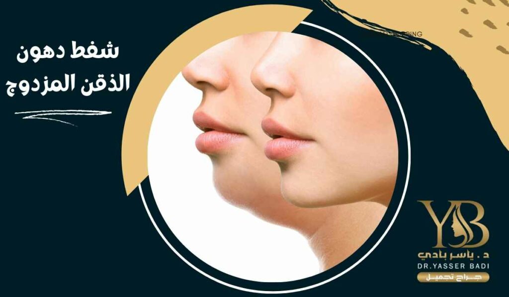 شفط دهون الذقن المزدوج