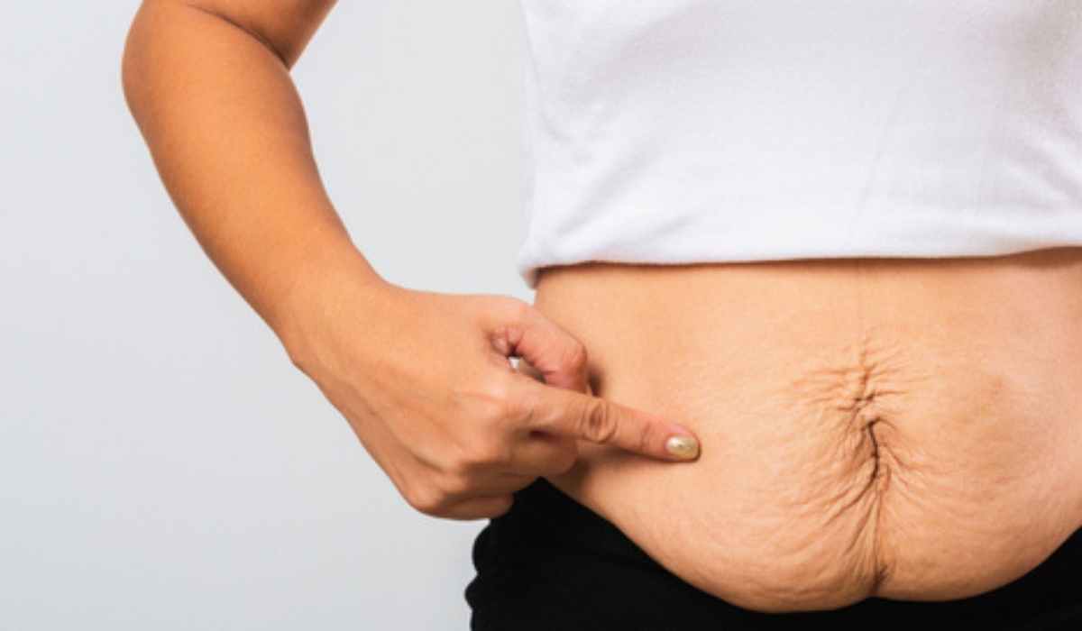 علاج ترهلات البطن