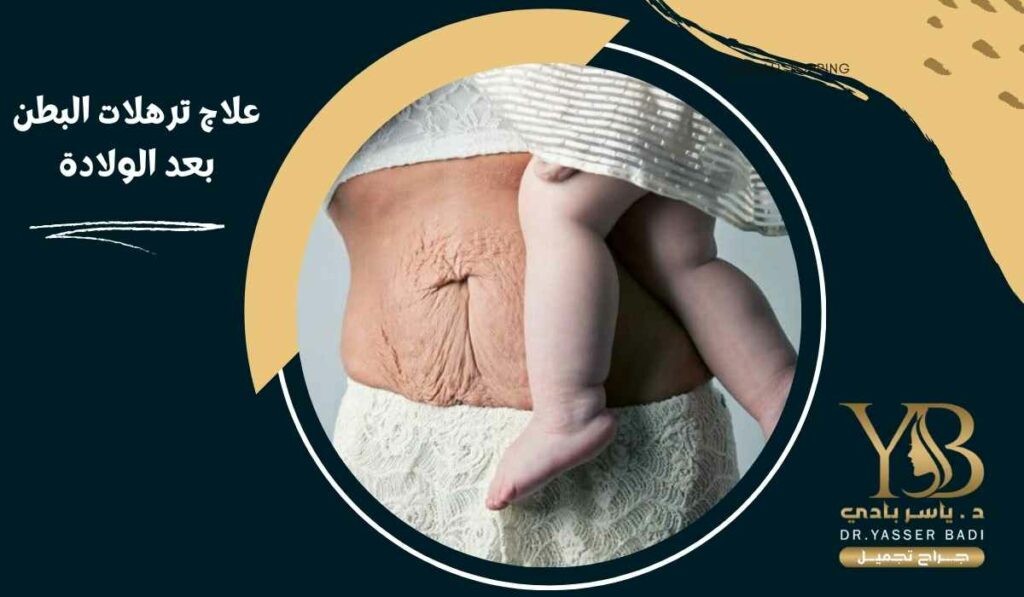 علاج ترهلات البطن بعد الولادة