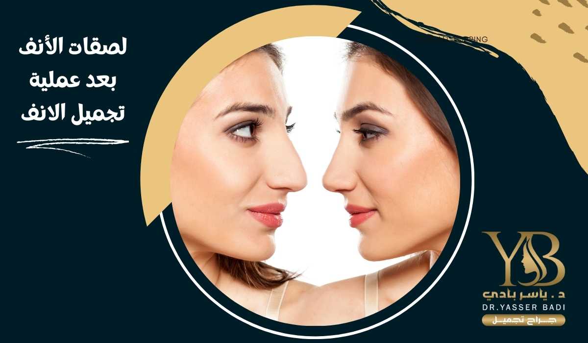 لصقات الأنف بعد عملية تجميل الانف