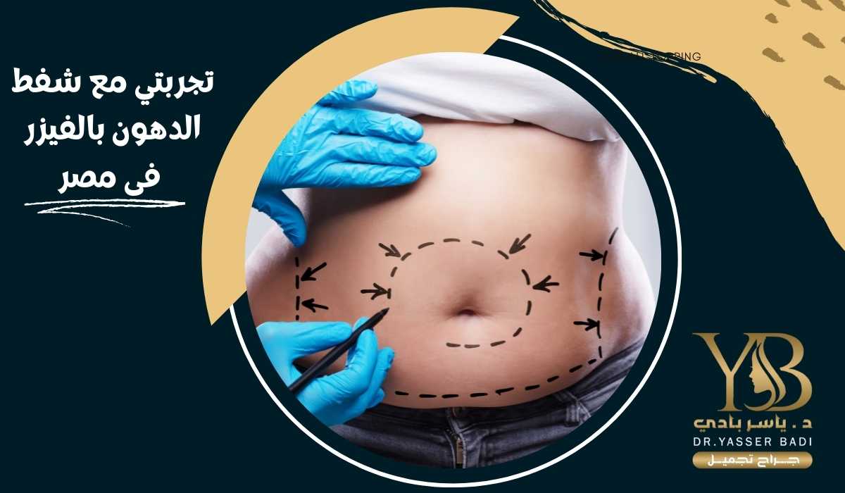 تجربتي مع شفط الدهون بالفيزر فى مصر