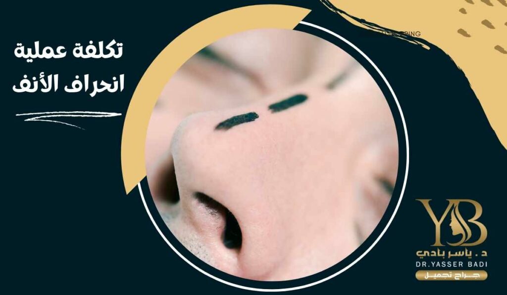 تكلفة عملية انحراف الأنف