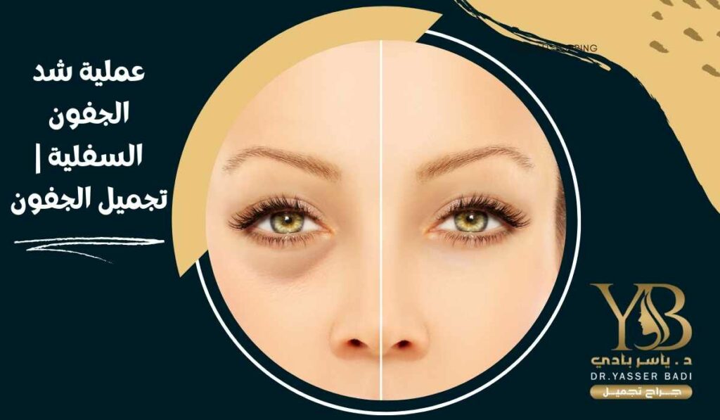 عملية شد الجفون السفلية تجميل الجفون