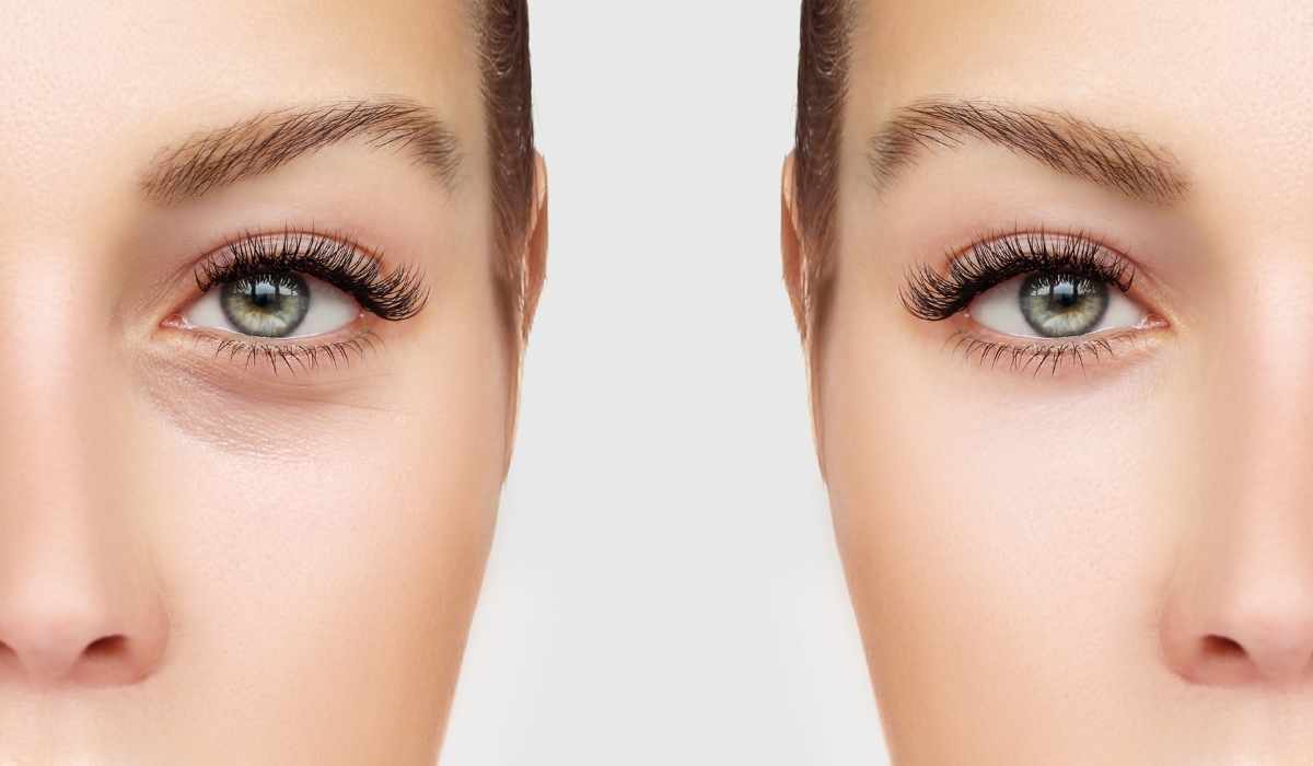 عملية شد الجفون السفلية تجميل الجفون