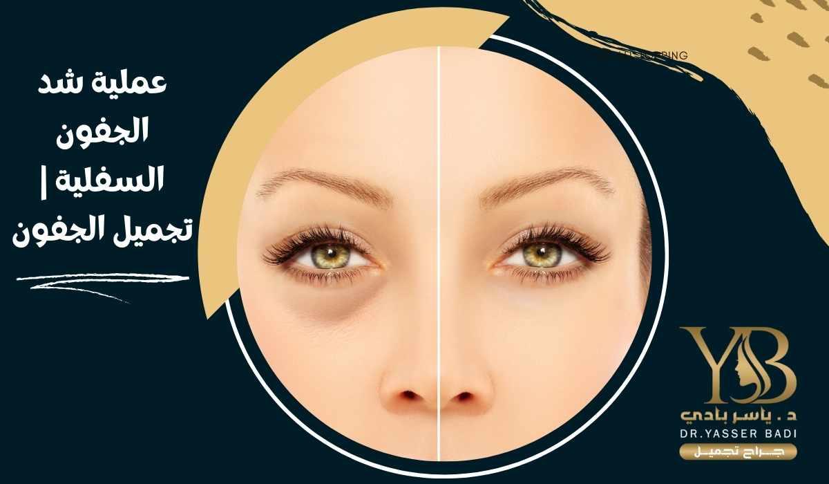 عملية شد الجفون السفلية | تجميل الجفون