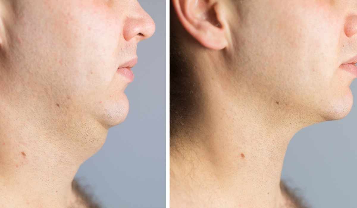 افضل جراح تجميل لشفط دهون الذقن