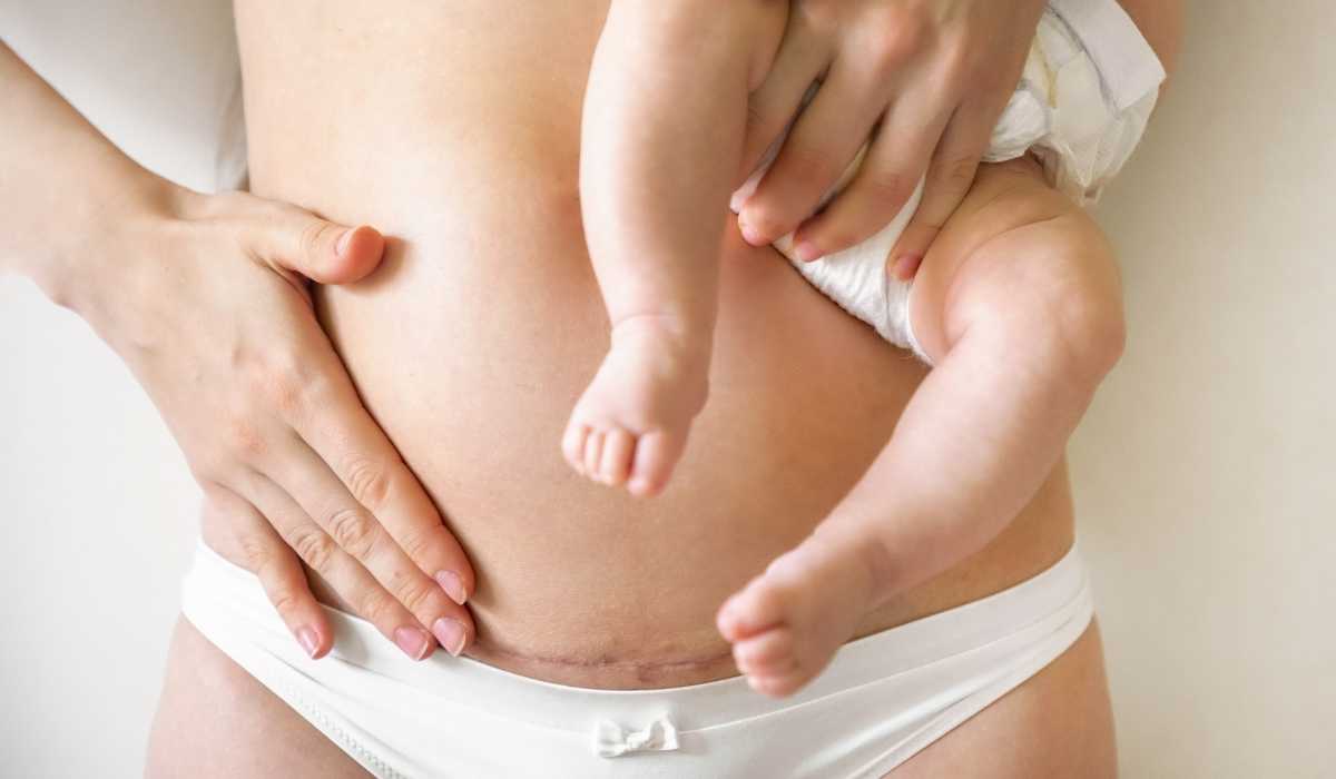 Advantages of saggy belly fat after birth
