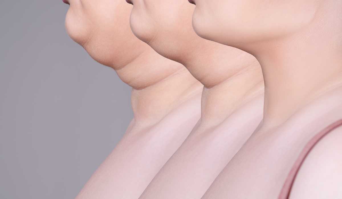 Double chin liposuction