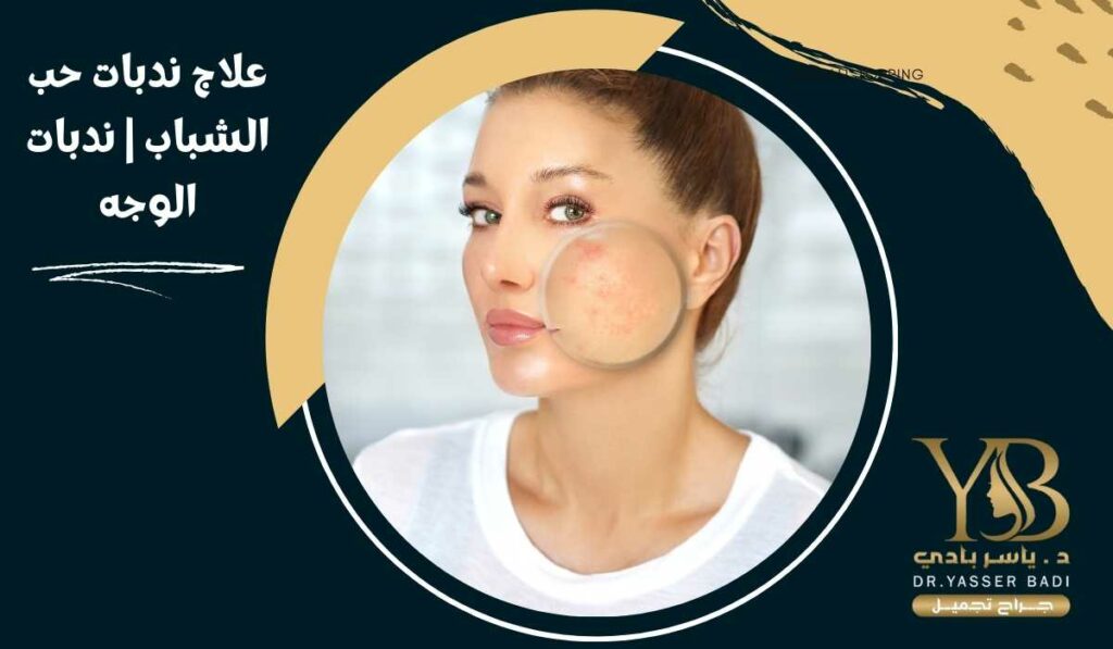 علاج ندبات حب الشباب ندبات الوجه