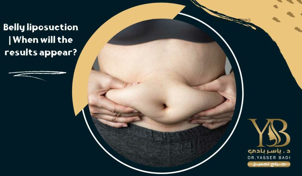 Belly liposuction When will the results appear