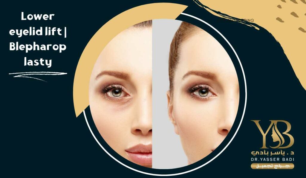 Lower eyelid lift Blepharoplasty
