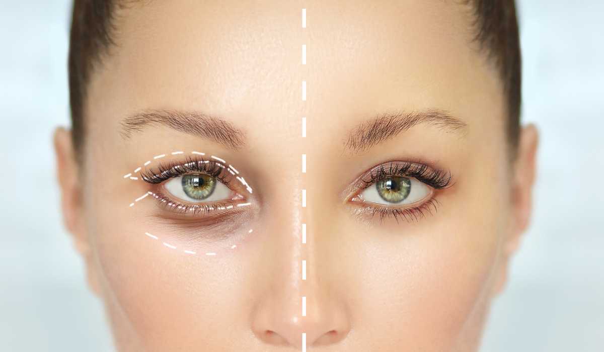 Lower eyelid lift Blepharoplasty
