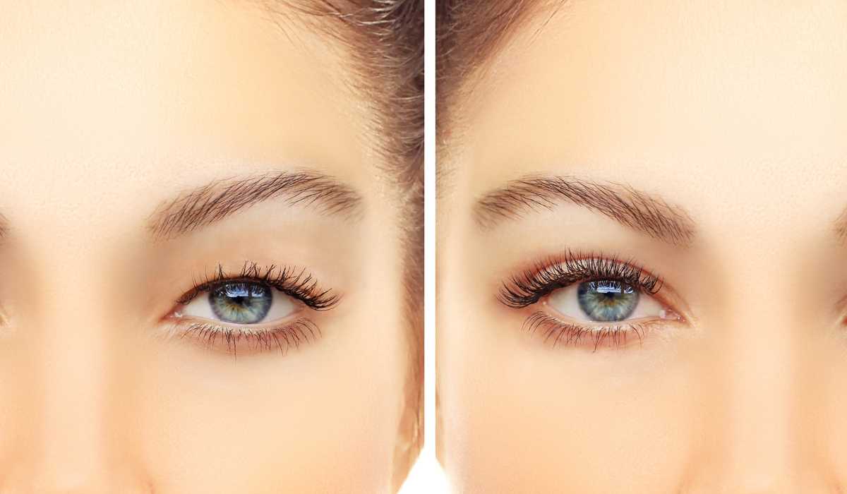 Upper Blepharoplasty techniques