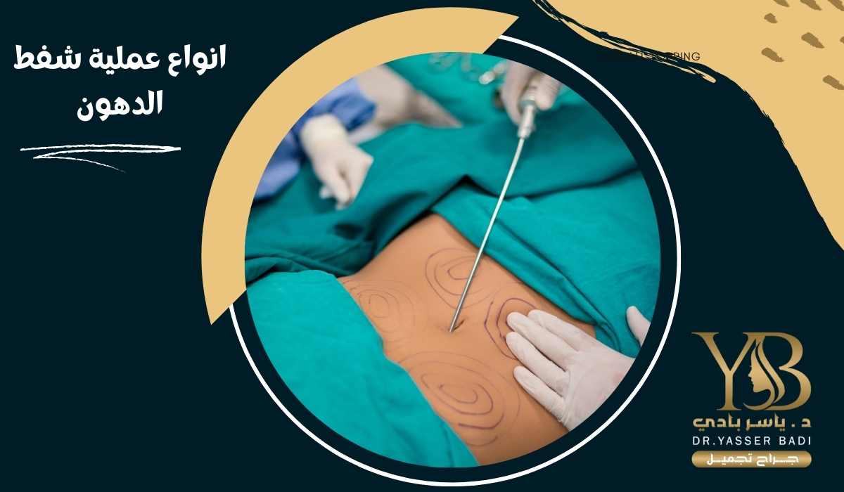 انواع عملية شفط الدهون