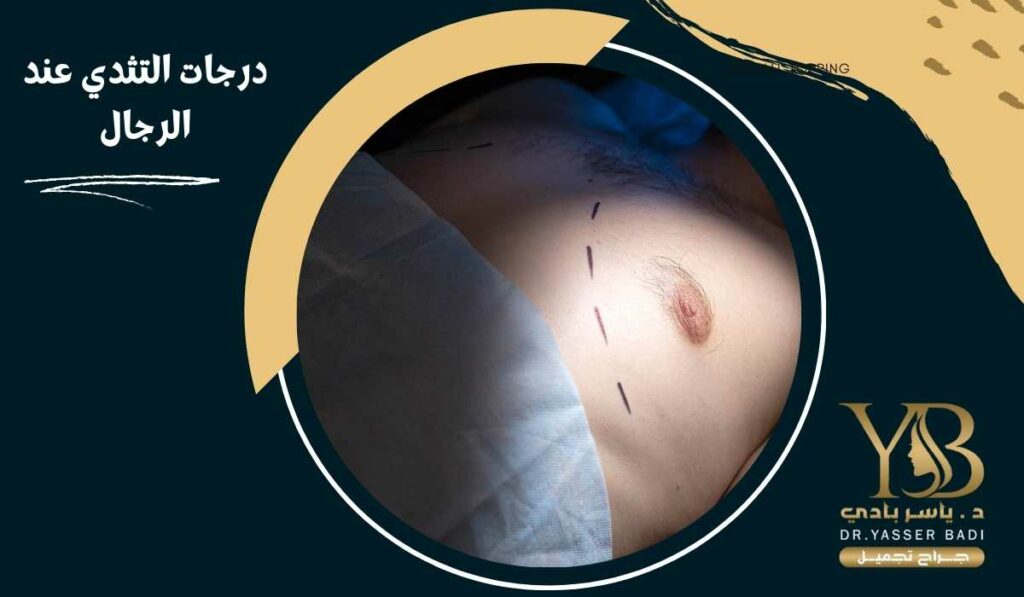 درجات التثدي عند الرجال