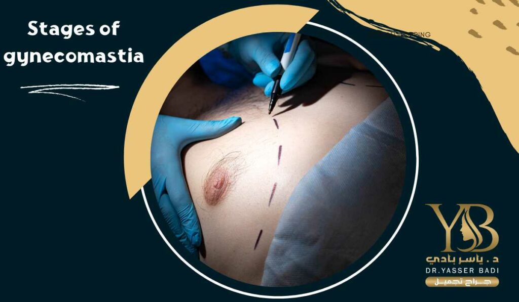 Stages of gynecomastia