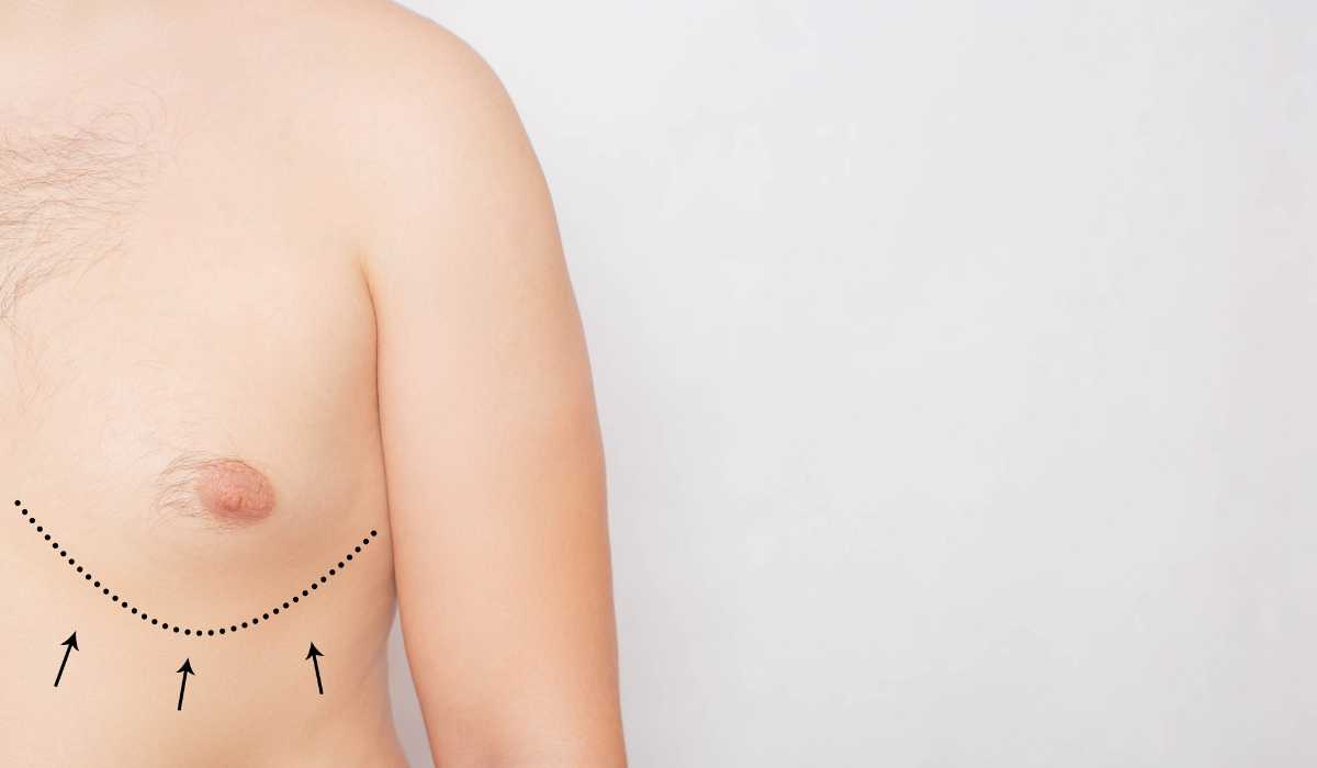 Stages of gynecomastia