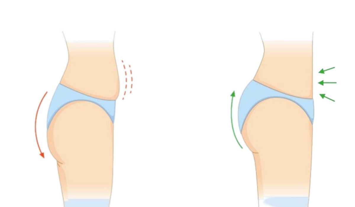 What is a Brazilian butt lift