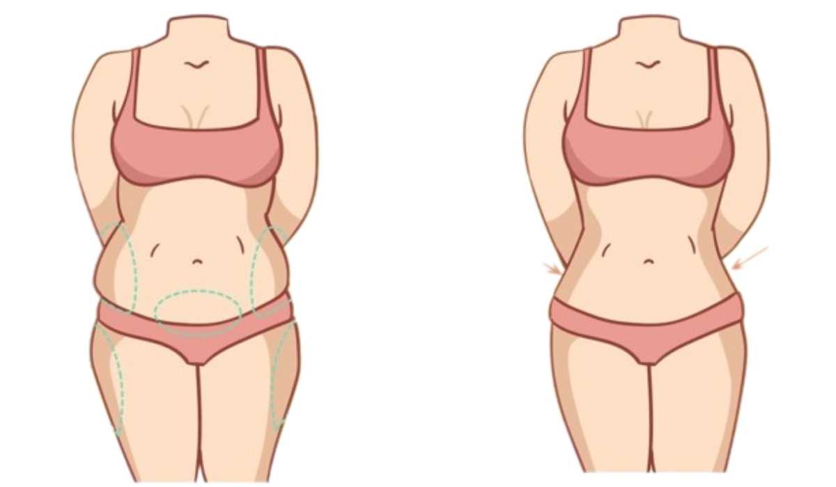 افضل دكتور تجميل في مصر لشفط الدهون