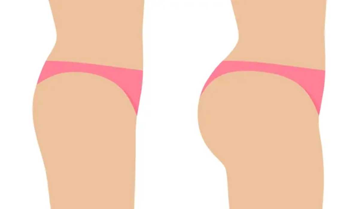 Best plastic surgeon in buttock augmentation