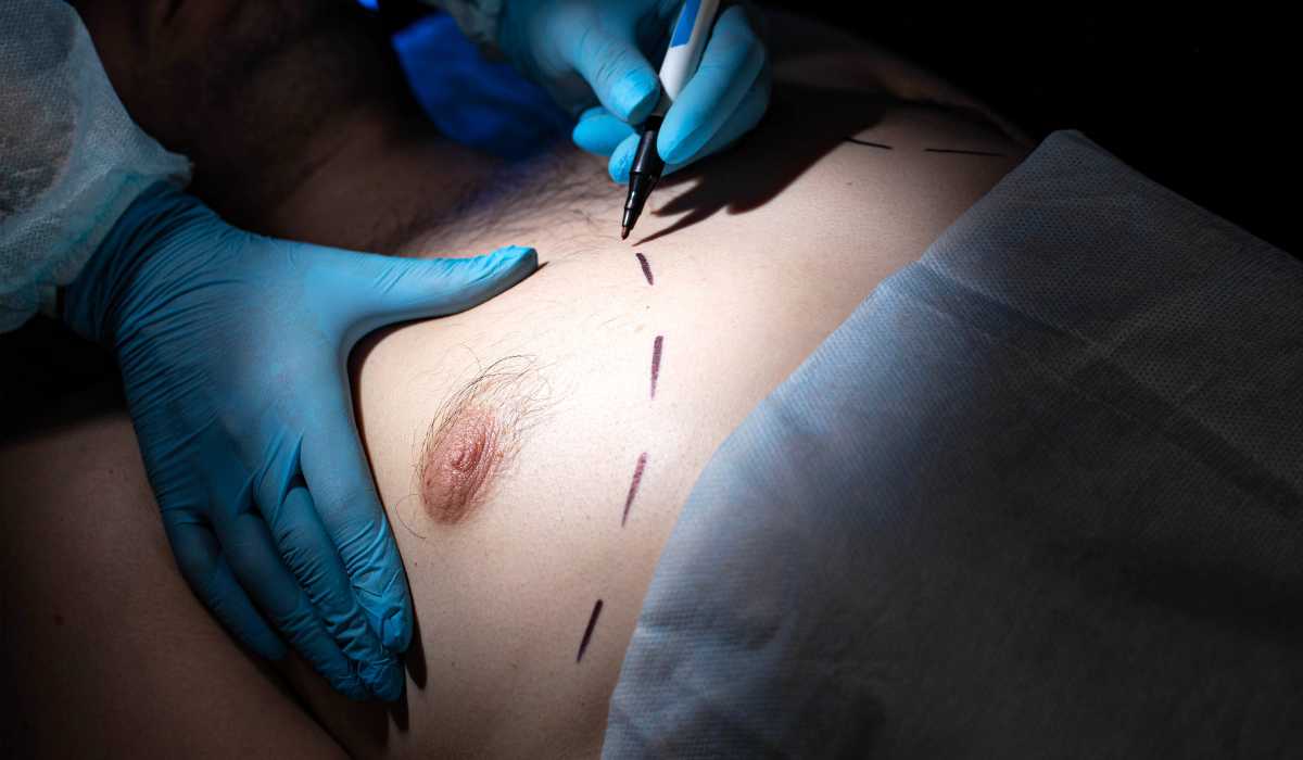 Causes of Gynecomastia