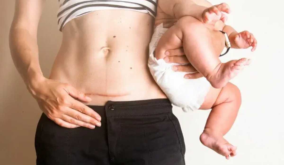 Mommy makeover surgery