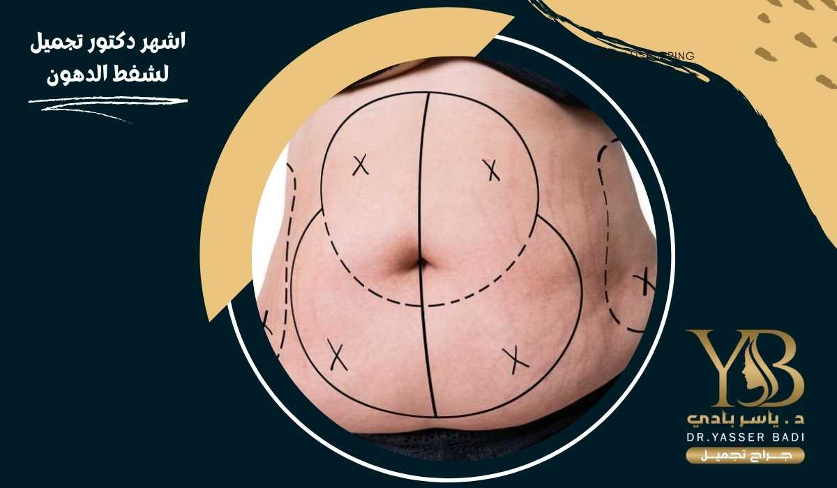 اشهر دكتور تجميل لشفط الدهون