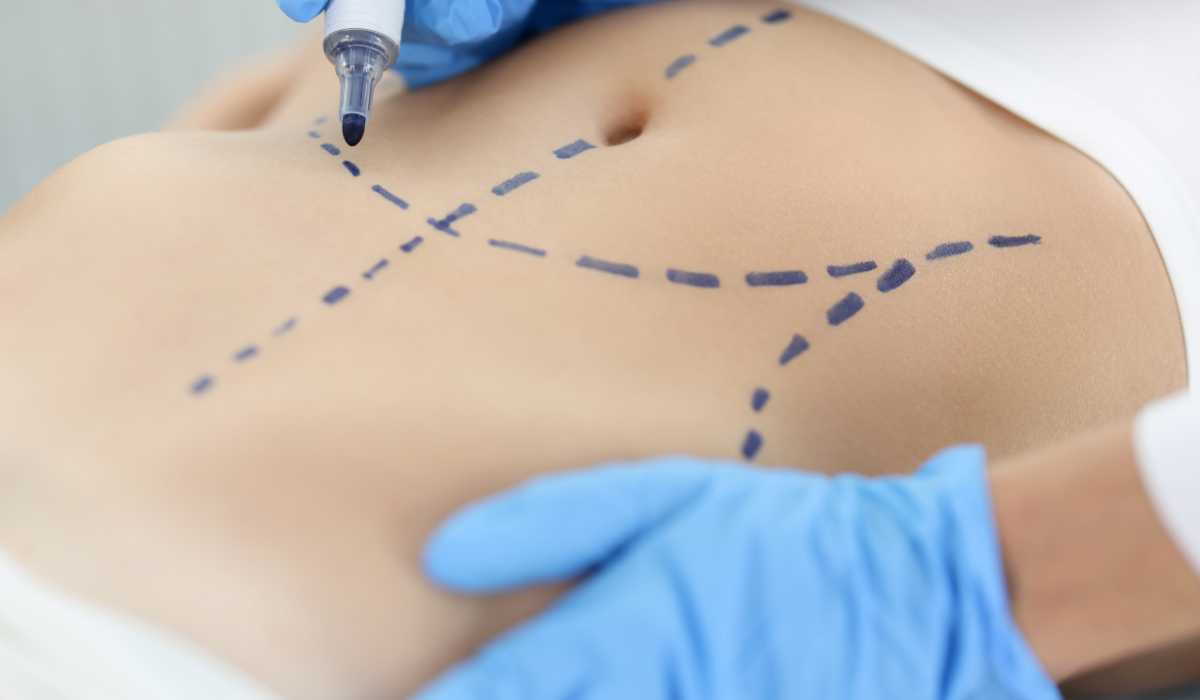 تكلفة عملية شفط الدهون مع افضل جراح تجميل