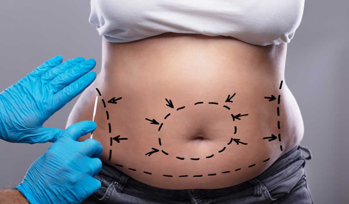 Best plastic surgeon for liposuction surgery