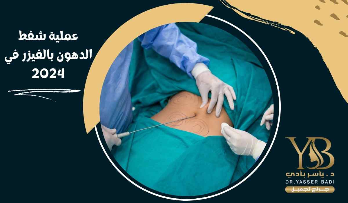 عملية شفط الدهون بالفيزر في 2024