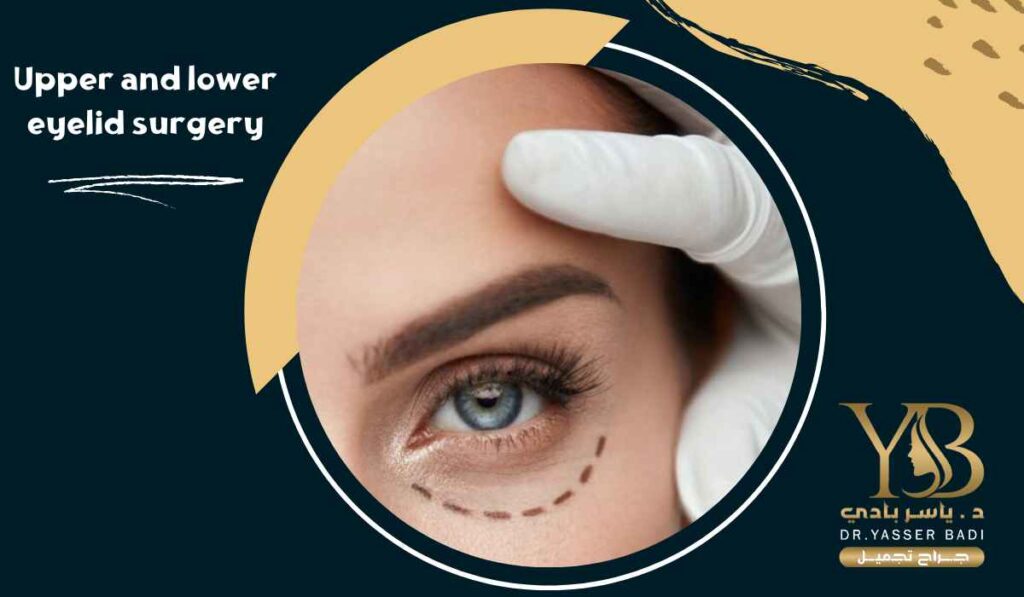 Upper and lower eyelid surgery