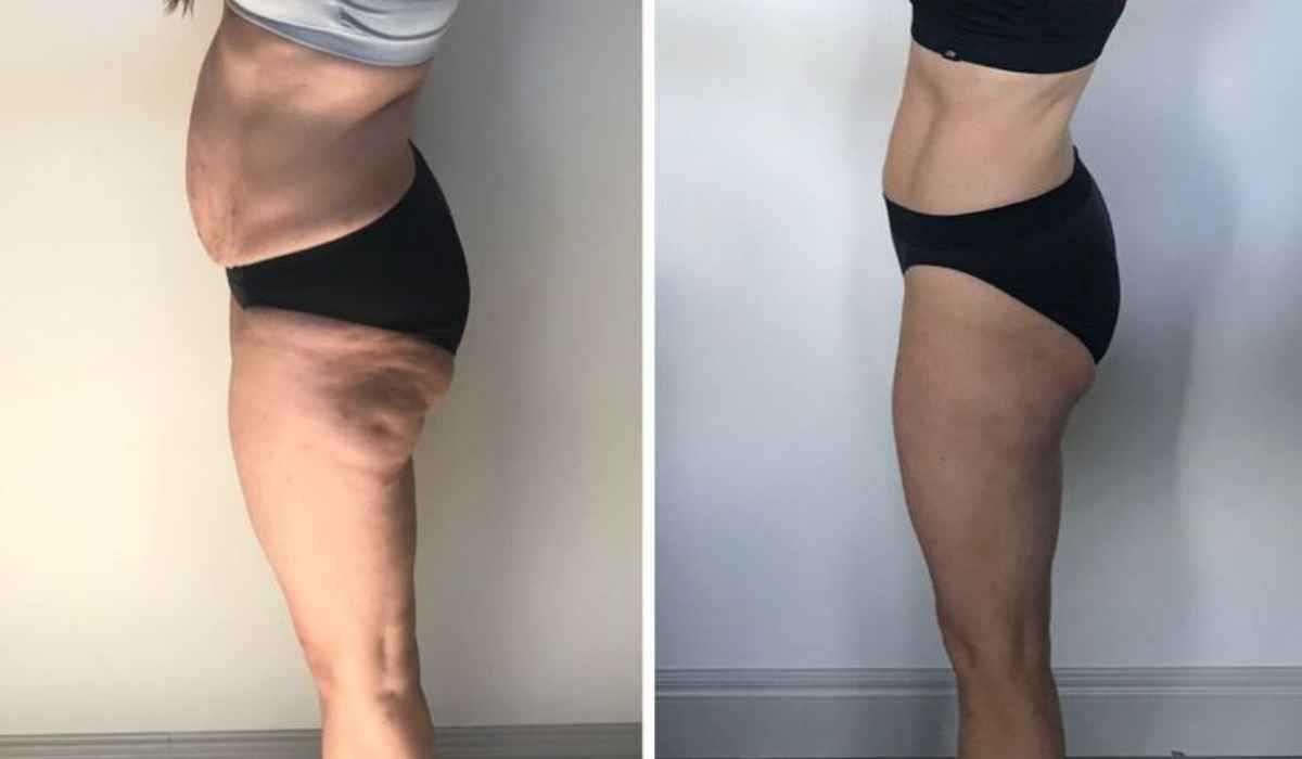 body sculpting before and after