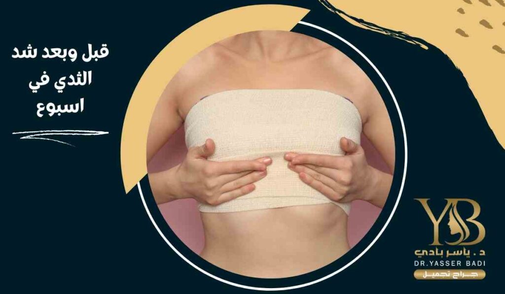 قبل وبعد شد الثدي في اسبوع