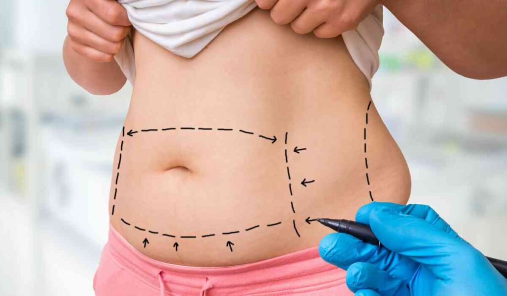 Liposuction Surgery Cost