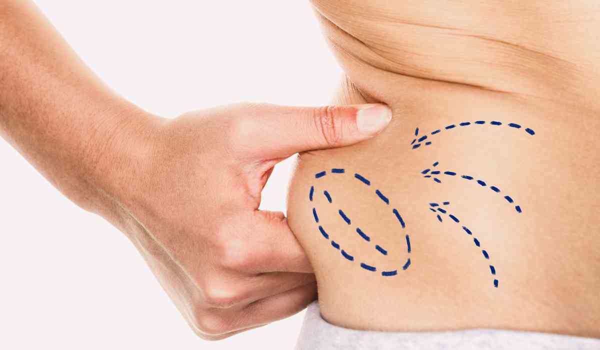 Best-plastic-surgeon-in-Alexandria-for-Liposuction