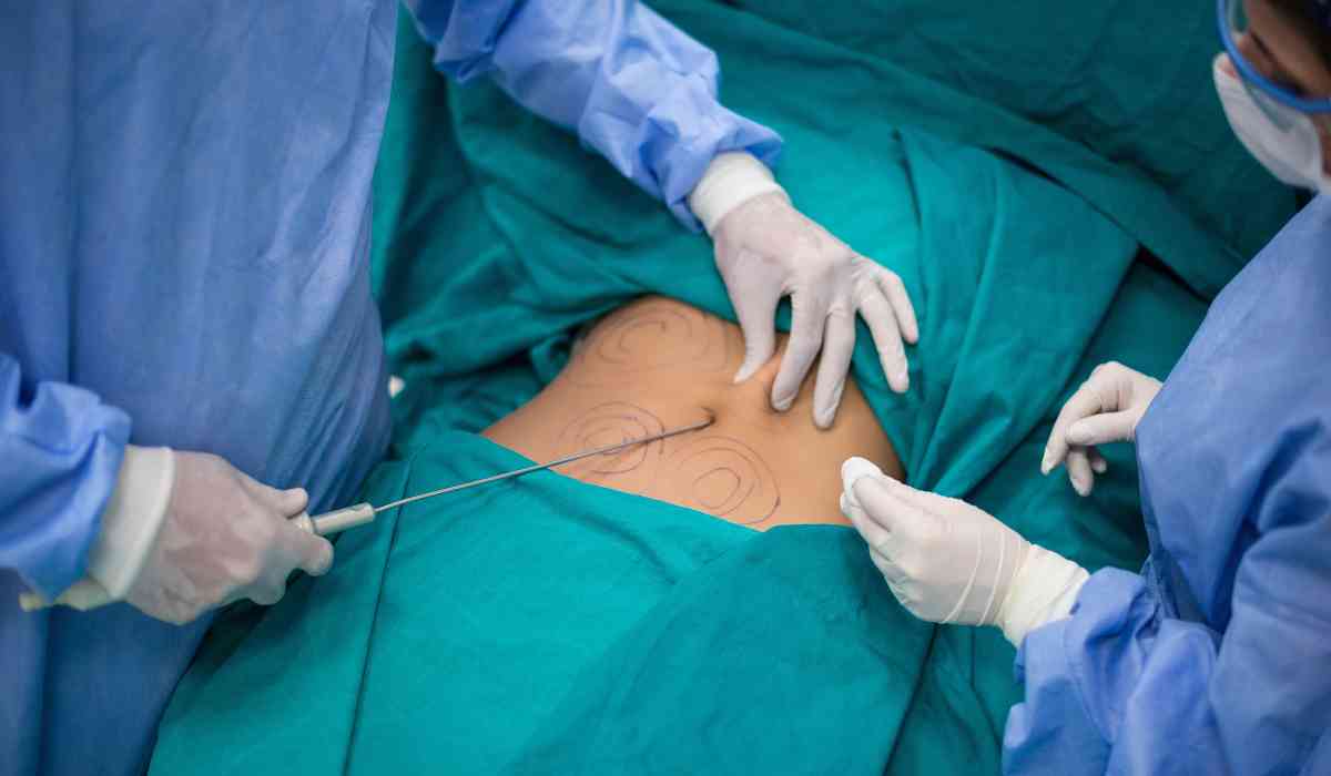 The-best-Vaser-liposuction-doctor